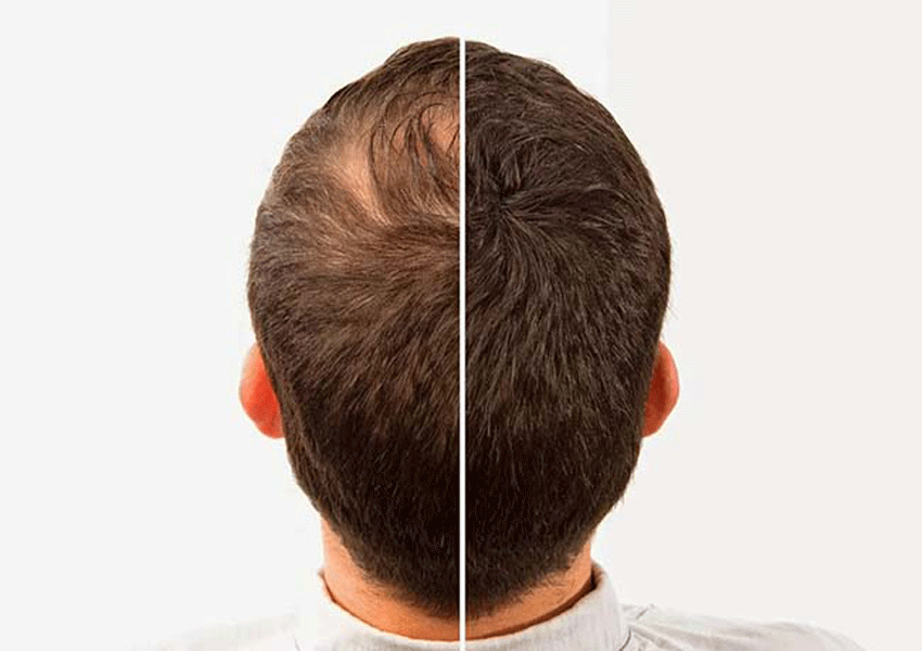 درمان ریزش مو توسط روغن زیتون